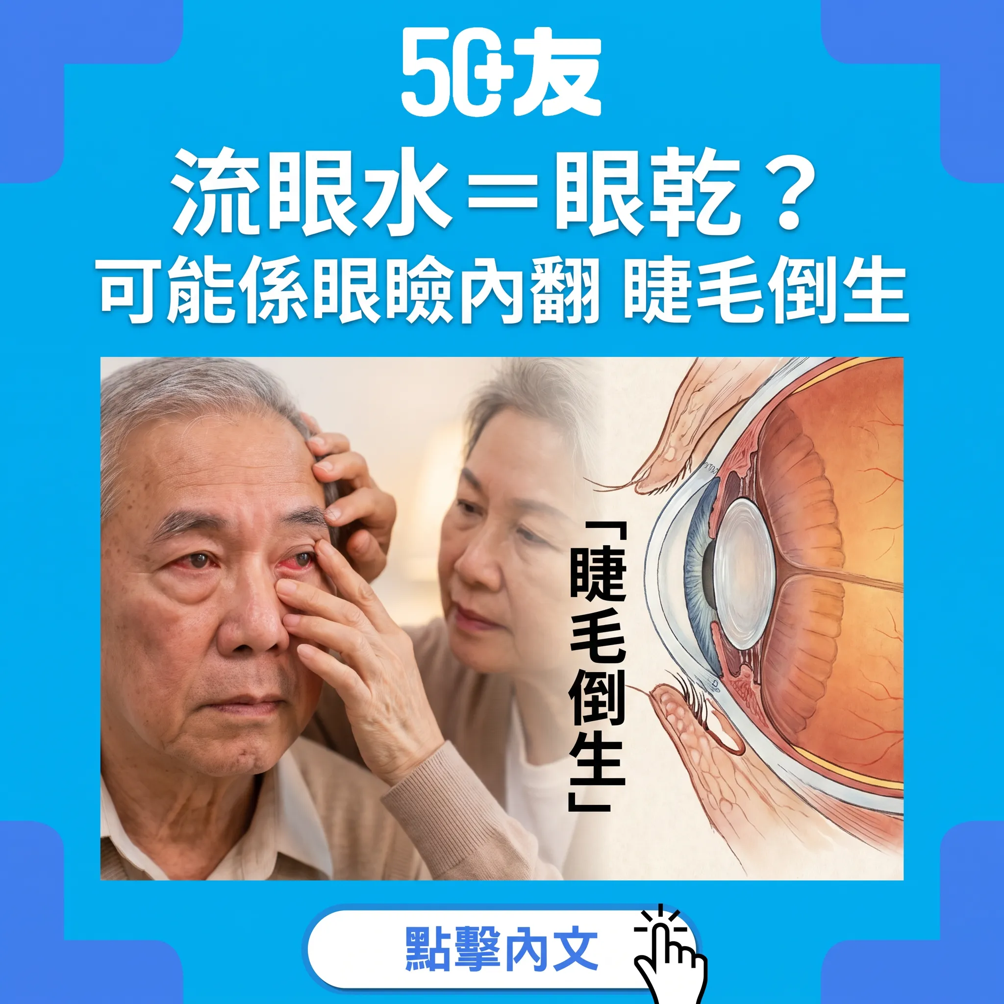 成日流眼水唔係眼乾——50+眼瞼內翻的真相與解法