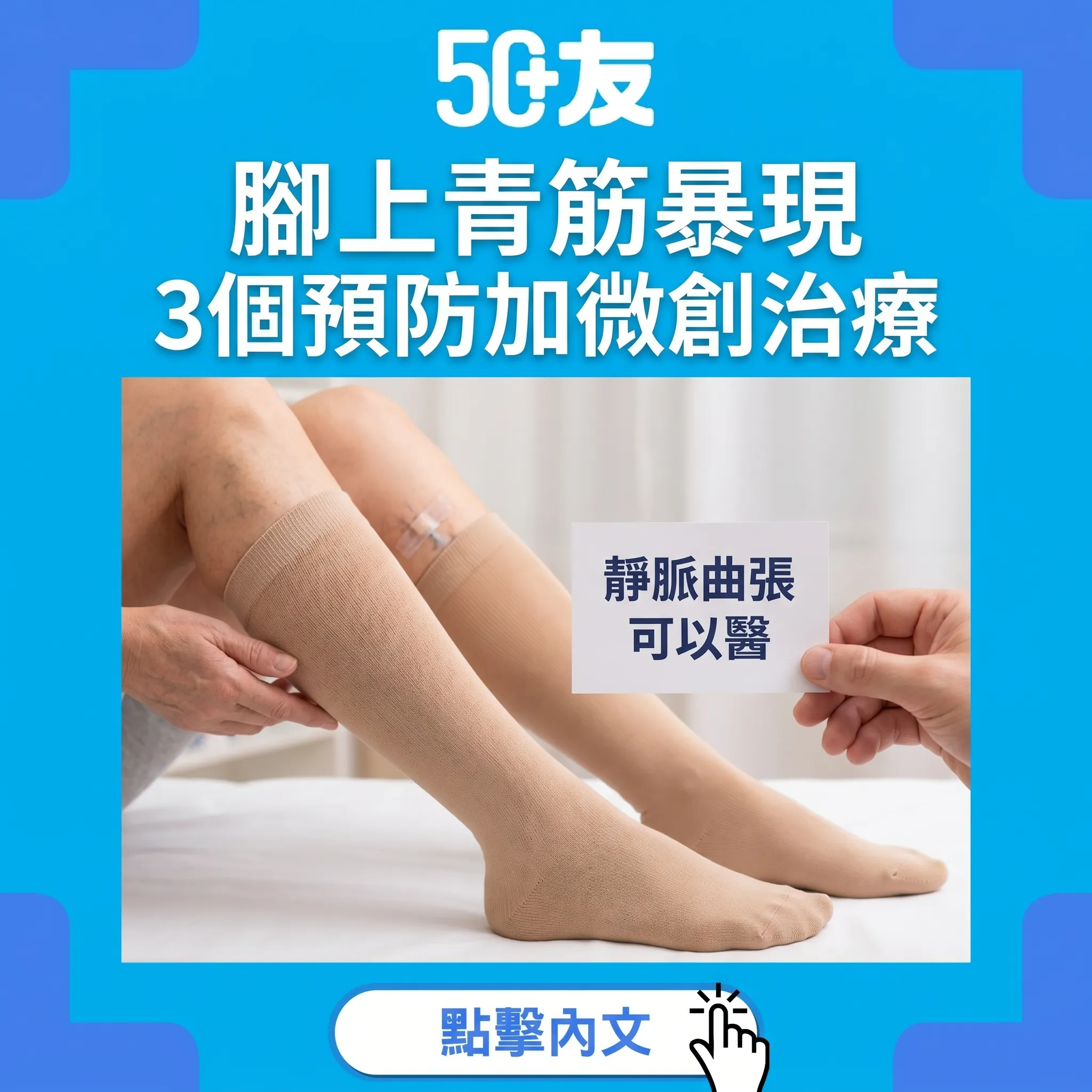50+靜脈曲張！3個預防加微創治療加血管科