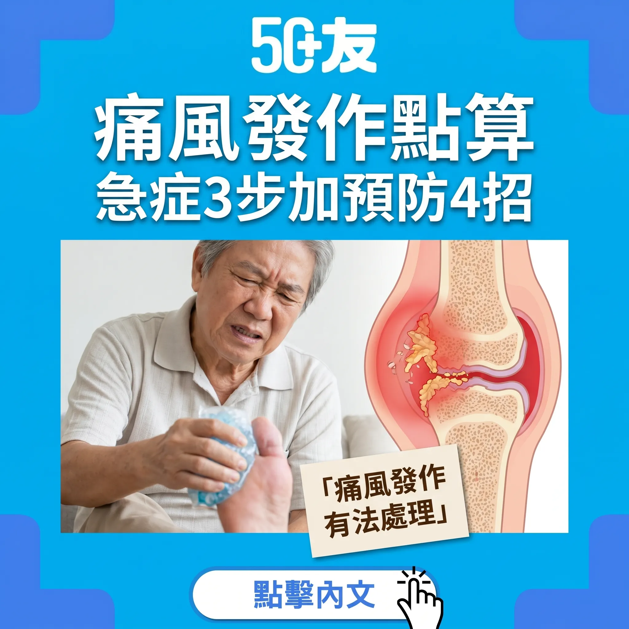 50+痛風急性發作點算？急症3步加止痛藥加預防4招