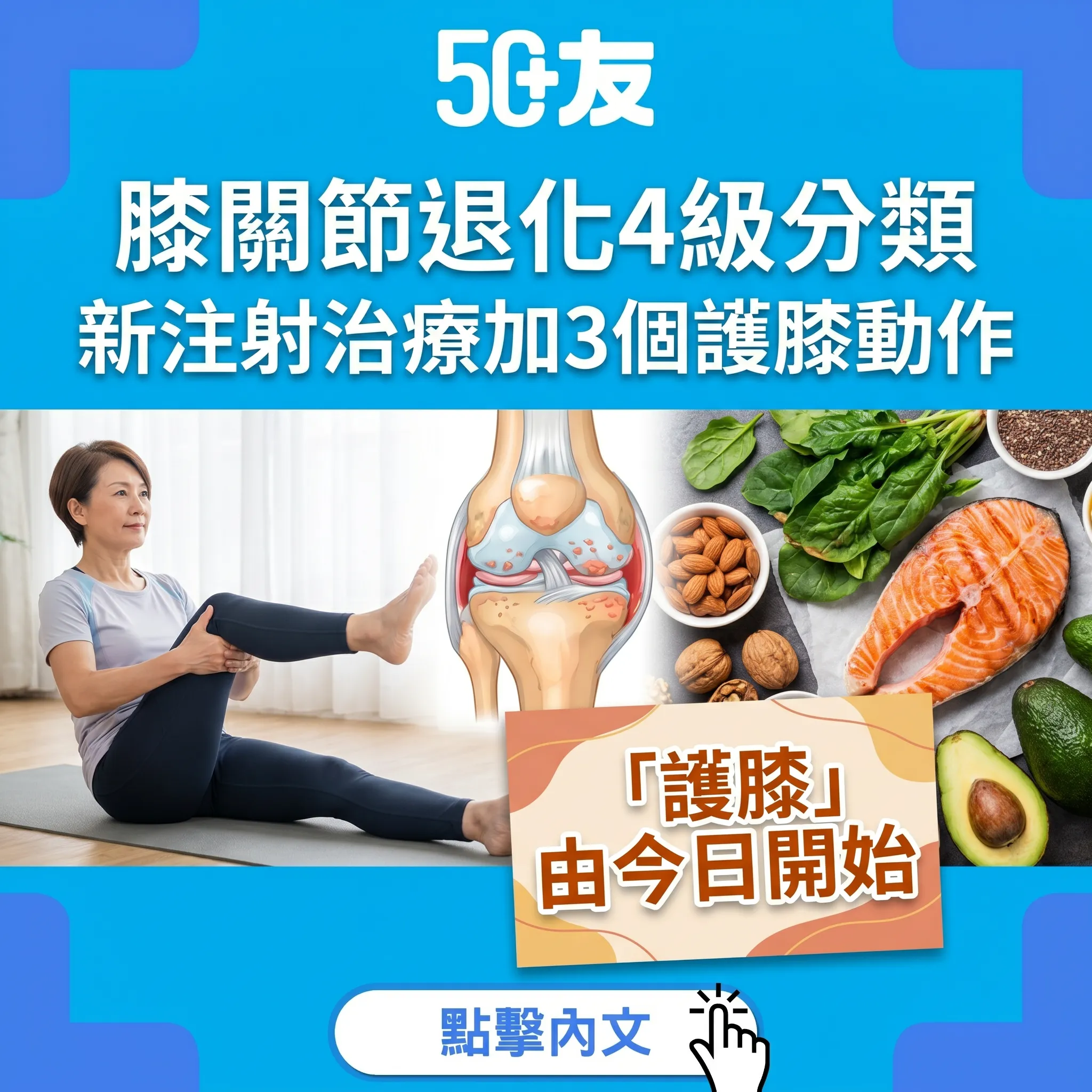 50+膝關節退化4級分類！新注射治療加3個護膝動物全攻略