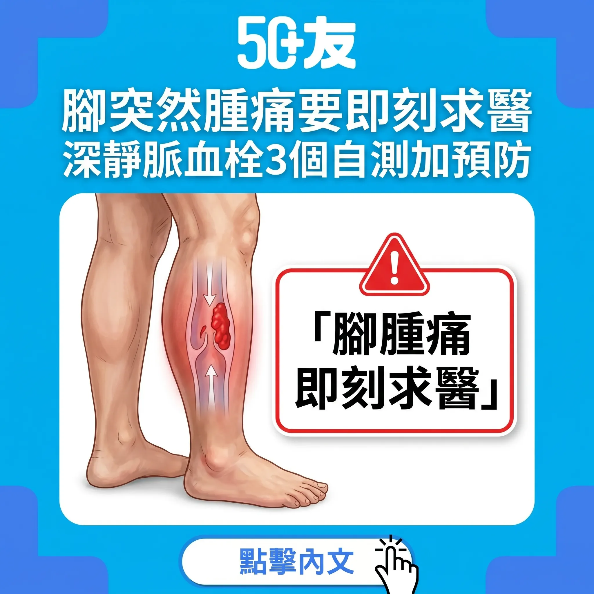 50+深靜脈血栓沉默殺手！3個自測加預防5招加香港急症處理