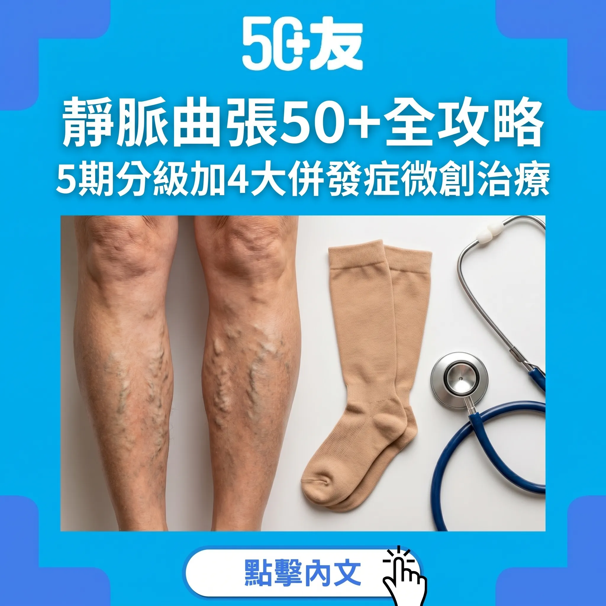 靜脈曲張唔只影響外觀！50+久站久坐高危全攻略