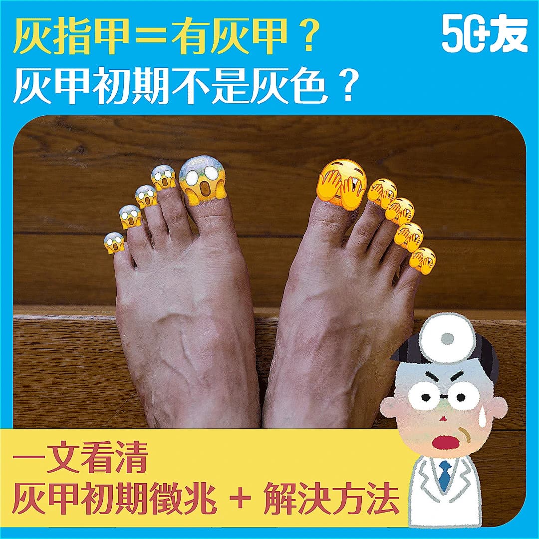 【灰指甲＝有灰甲？】灰甲初期不是灰色？一文看清灰甲初期徵兆+解決方法