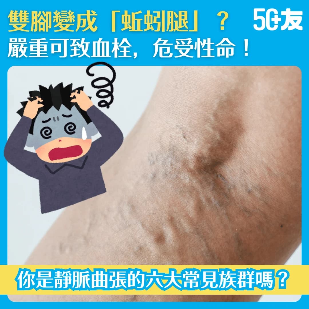 【靜脈曲張到底是甚麼？】從成因、症狀、預防到最新治療方法