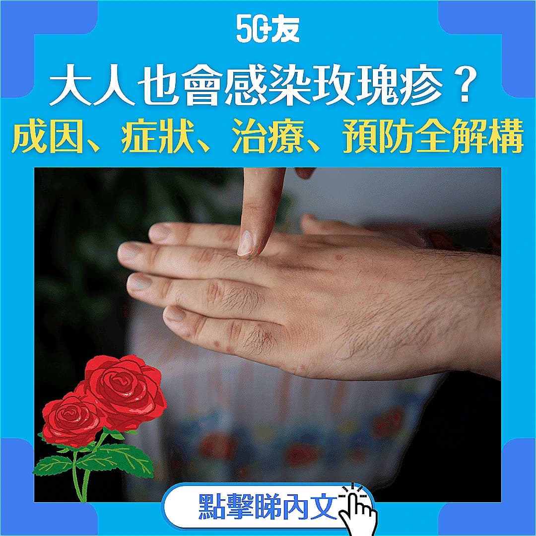 【玫瑰疹】成年人也會患上玫瑰疹 認識玫瑰疹症狀、治療方法及預防措施