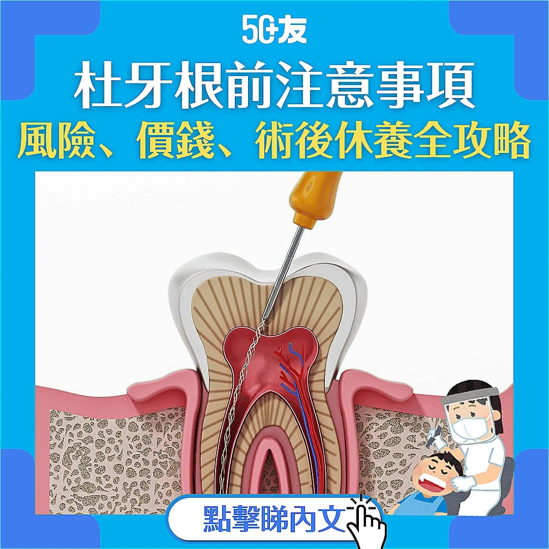 【牙齒健康】杜牙根是甚麼？為你介紹手術風險、價錢、後遺症等資訊